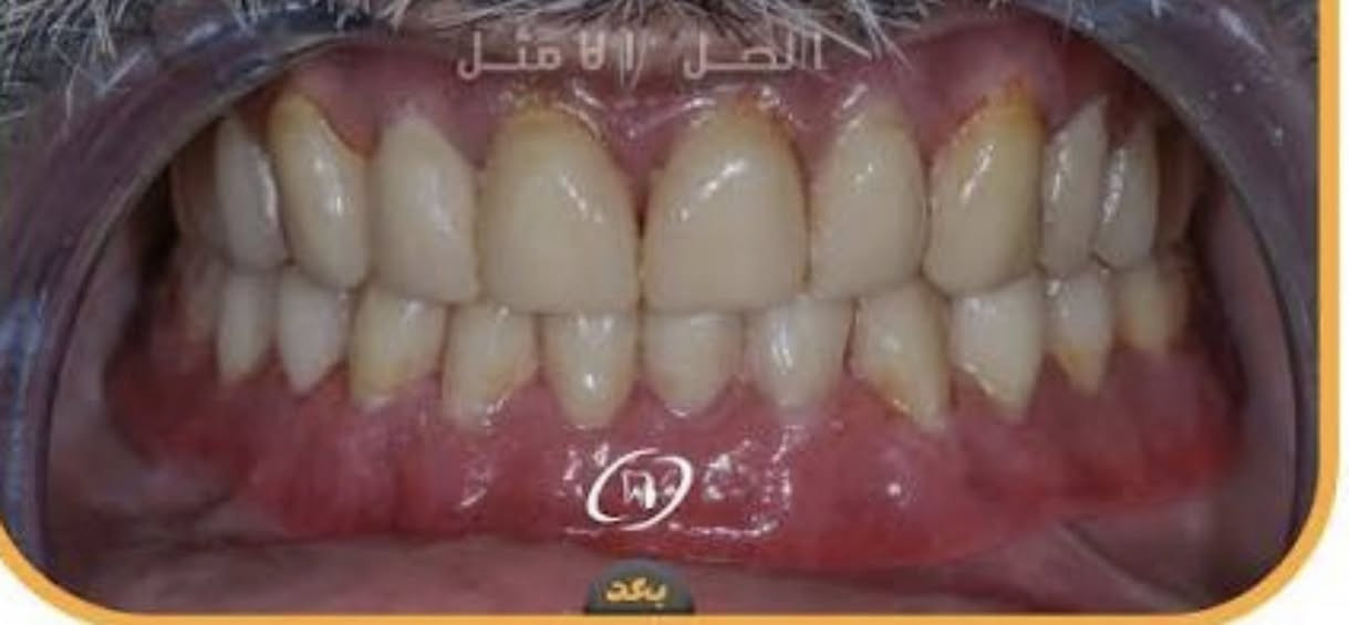 السلام عليكم منشور للفائدة  اني الدكتور محمد صادق طبيب أسنان                  

                                                      اي احد يعرف ناس حالتهم الماديه ضعيفه عنده أطفال أسنانهم متسوسه أو اهلنا الكبار بالعمر الي فاقد كل اسنانه توفر يمنا تركيب أسنان طقم كامل لتحسين  المضغ والنطق وعنايه كامله باسنان الأطفال يضمن جلسات فلورايد لتقليل التسوس ( العمل مجاني ) 
العنوان / الحلة شارع ٤٠ مجاور صيدليه سلامتك 

  *********** 📞
