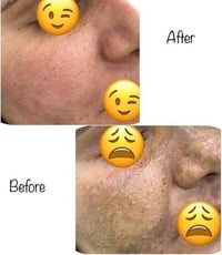 علاج الكلف • تبييض البشرة • ازالة اثار الحبوب