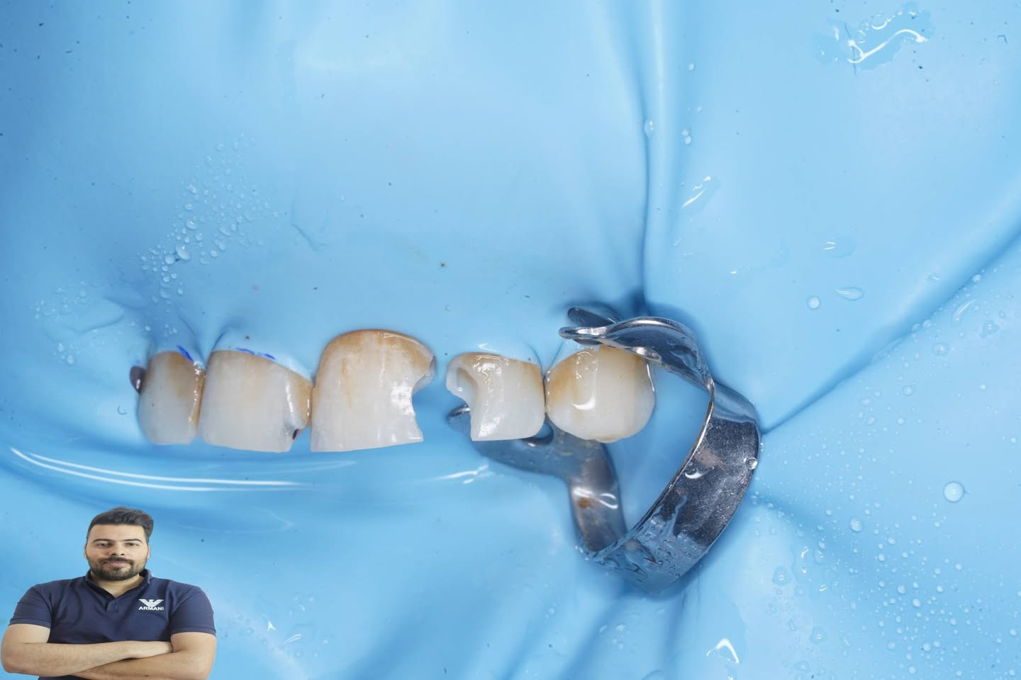 مراجعة عدهة تسوس بين الاسنان ومخرب شكلها سوينالهة حشوتين بحلسة واحدة ورجانة شكل الاسنان الطبيعي

العنوان /المسيب / شارع البلدية / مجاور عالم الحليب 

للحجز والاستفسار
***********
***********
