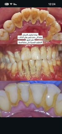 تعويض اسنان • طقم اسنان • قلع اسنان • تنظيف اسنان • حشوات اسنان • عياد...