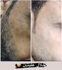 تبييض • بشرة دهنية • كلف