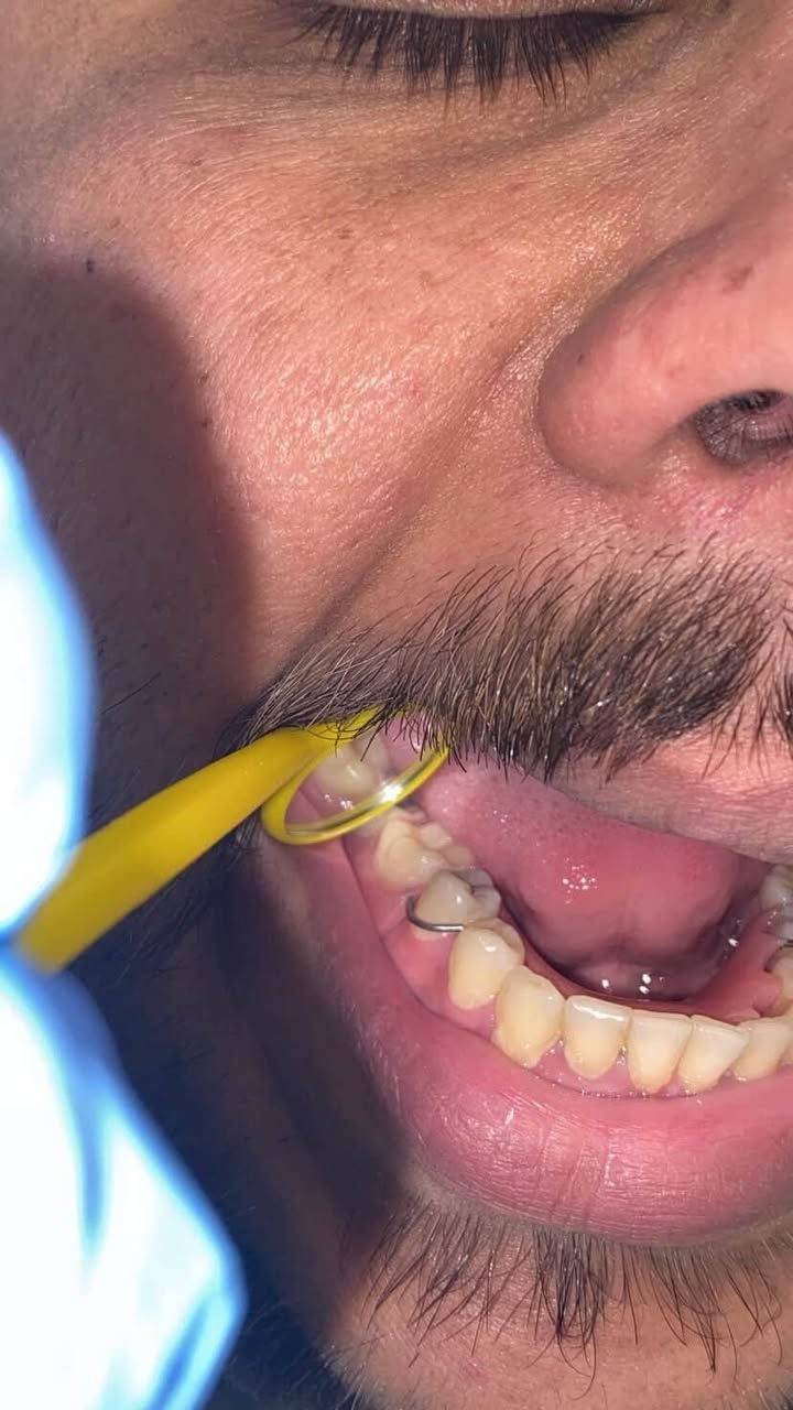 مجانا يتوفر قلع جذور الاسنان واسنان متحركة واستبدالها بطقم متحرك تواصل خاص او واتساب رقم***********
