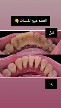 الي عنده تكلسات بالاسنان مثل الحاله الي بالصوره ويحتاج تنضيف اسنان مجا...
