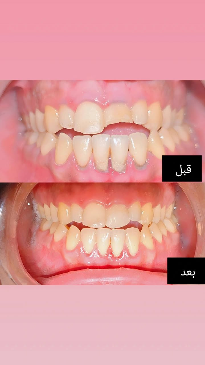 السلام عليكم 
 متواجدين بعيادة اصلان 
لقسمين الاسنان والتجميل 
يوميا من الساعه 4 ولليل حسب الحجوزات 
للحجز ***********
نستقبلكم بكل حب 💙
