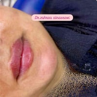 فلر شفة • تحديد الذقن • المسيب حي المعلمين