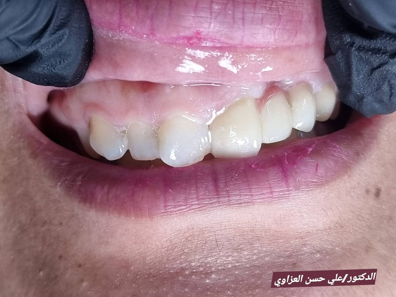 طابت جمعتكم ونفوسكم
 الطيبة
بالخير والبركات
جمعة مباركة عليكم

💙💫 💙💫

من اعمالنا اليوميه في عيادتنا
#عيادة_كوثى_لطب_وتجميل_الاسنان

تغليف الاسنان بجسور الزاركون💯💯
💫 ارجاع الشكل التشريحي والوظيفي للاسنان المفقودة 
وبطريقة تماثل شكل ولون الاسنان المجاوره💙
 
💪دقة تفاصيل وقوة 
💙💙وبضمان العمل والجودة

#عيادة_كوثى_لطب_وتجميل_الاسنان

جبله/شارع الاطباء
مقابيل الدكتوره ميثاق المعموري

***********
