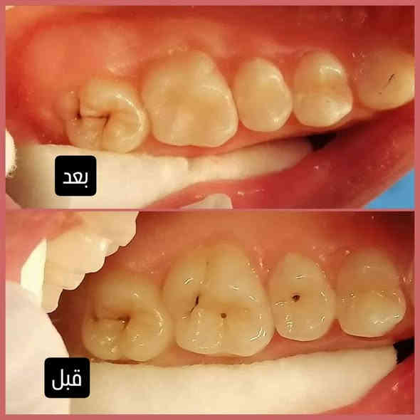 � ابتسامتچ… سر جاذبيتچ! 💫🦷
دتمحلمين بابتسامة حلوة وأسنان نظيفة؟
إحنا وفرنالج كلشي بمكان واحد وبأحدث الأجهزة والخبرة ✨

قسم الأسنان عدنا يقدملچ:
▪️ شغل مرتب
▪️ مواد أصلية
▪️ أسعار مريحة
والمفاجأة؟ 🎁
إذا شغلچ أكثر من مليون دينار، نقسطه إلج بدون فوائد! 😍💸

📍 العنوان:
ديالى – خانقين – حي رمضان – شارع المحكمة – قرب دائرة الكهرباء ⚡

📞 للحجز والاستفسار:
***********
***********

🕒 أوقات الدوام:
من 10 الصبح لـ 1 الظهر
ومن 4 العصر لـ 9 بالليل
طوال أيام الأسبوع 🌿

📲 تابعونا حتى توصلكم العروض أول بأول
وخلي أسنانچ تصير قدوة بالبياض والجمال 😁✨
