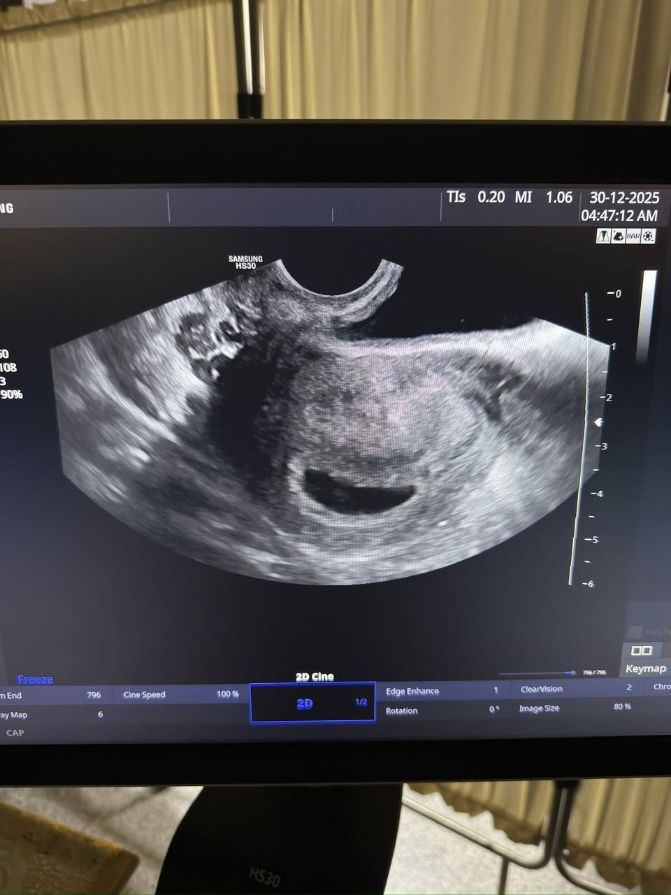 مراجعة لديها عقم اولي ٣ سنوات مع تضيق شديد في عنق الرحم ادى الى صعوبة شديده لاجراء عملية اشعة الانابيب مع تكيس المبايض 
بعد عمل الاجراءات المناسبة لعلاجها 
اليوم بشرنا بحملها ٥ اسابيع 🥰 

متواجدين في الساعة ٣:٣٠ مساءً في حال حابين تحجزون ع الرقم او عن طريق مراسلة الصفحة على الخاص 💌

نستقبلكم بكل حب واهلا وسهلا بيكم ❤️

كركوك _ حي الحجاج - مجمع الخليج الطبي قرب جسر غرناطة للحجز عبر الدايركت او الاتصال على الرقم الآتي:

0772 836 2378
