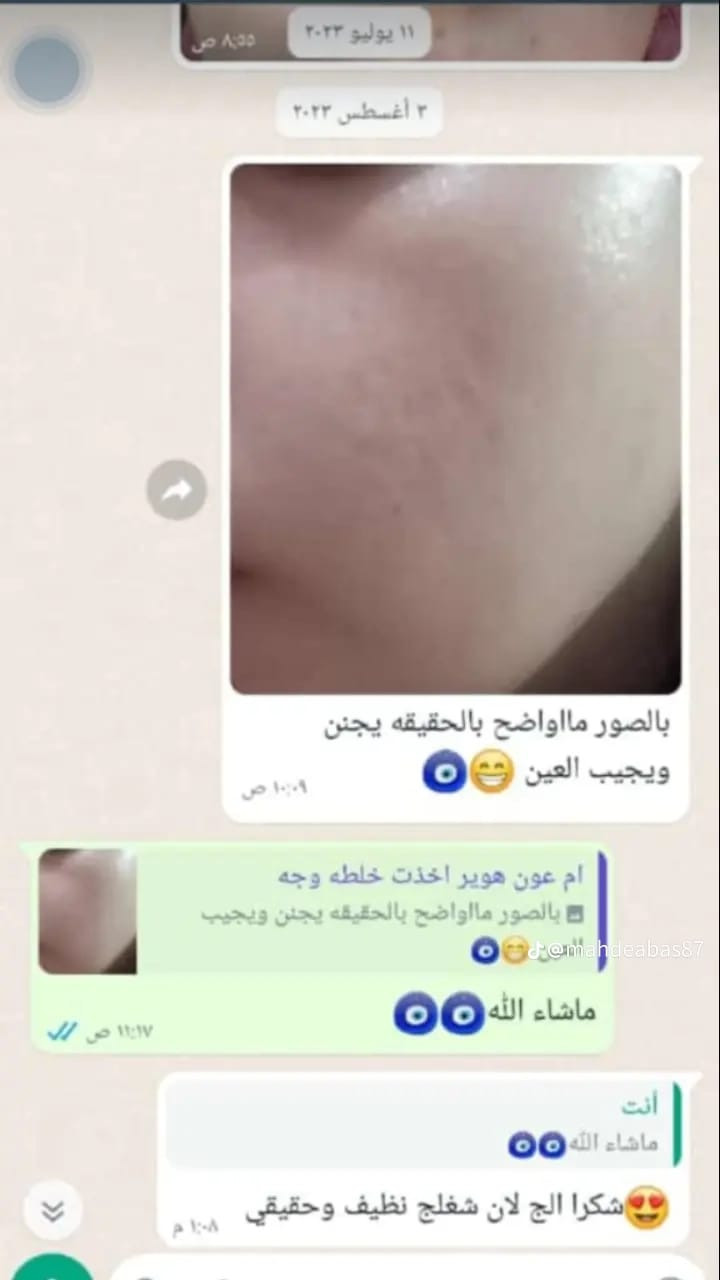 وجهك هو مرايتك.. خليه ينور بالعيد! ✨
​تعبانة من النمش وكلف، الشحوب، أو مظهر البشرة المجهد 
تصفيه ونضاره لوجهه
توصيل لجميع المحافظات  متوافر


**إذا كنت صاحب هذا الإعلان وتريد حذفه لأي سبب، رجاءا أرسل رسالة إلى الدعم الفني**