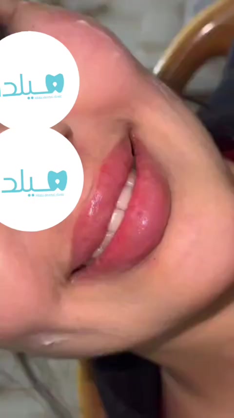 فلر شفه + ذقن 100
عيادة هيلدا لطب الأسنان والتجميل ||
📍 العنوان / الحريّة الثالثة – الدولعي
قرب السوق – فوق مجمع الكوخ
📞 للحجز والاستفسار (*********** )
نورونا وشرفونا بحضوركم
