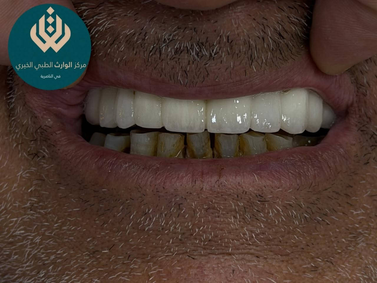 راجعنا المريض يشكو من بروز بالاسنان وتاكل بل الاسنان وفقدان الاسنان واصفرار ونخور بالاسنان 
قمنا بعمل الاجراء لازم وعمل تغليفات زيركون 
من اعمال طبيبنا المتميز🫡
د محمد السخي
📍 متواجدين يومياً طول أيام الأسبوع:
⏰ من الـ9 الصبح للـ12 الظهر
⏰ ومن الـ2:30 العصر للـ9:30 بالليل

📞 للتواصل ويانه:
✅ العيادات البشرية: ‎***********
✅ عيادات التجميل: ‎***********
✅ عيادات الأسنان: ‎***********

📍 العنوان: الناصرية – شارع بغداد، مجاور مدرسة الجواهري الأهلية
