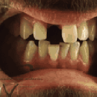 تركيبات زيركون • أقساط • الرمادي شارع المستودع