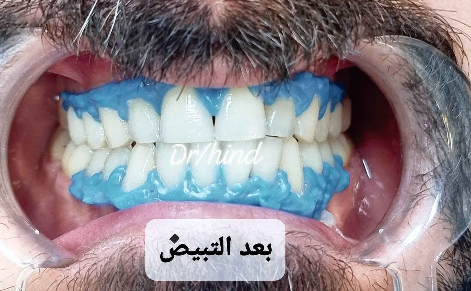 ✨ عروض العيد لتعديل الابتسامة ✨
عيادة دكتوره الدكتورة هند الحسيني 
خلي ابتسامتكم أحلى بهالعيد 😍🦷
🎀 تبييض الأسنان بالليزر
🎀 سد الفراغات بالحشوات التجميلية
🎀 تنظيف وتلميع الأسنان
🎀 ابتسامة دايركت فينير بدون برد
ابتسامة مرتبة وطبيعية من أول جلسة ✨
📩 للحجز والاستفسار مراسلة خاص
او على الرقم ***********
📍الحجز مسبق والأماكن محدودة
@إشارة
