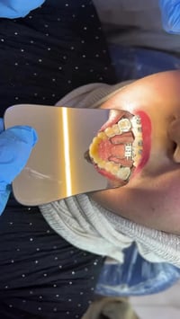 ليش نحتاج نوسع الفك ؟!! تابعو الفديو حتى تعرفون اسباب ضيق الفك العلوى ...