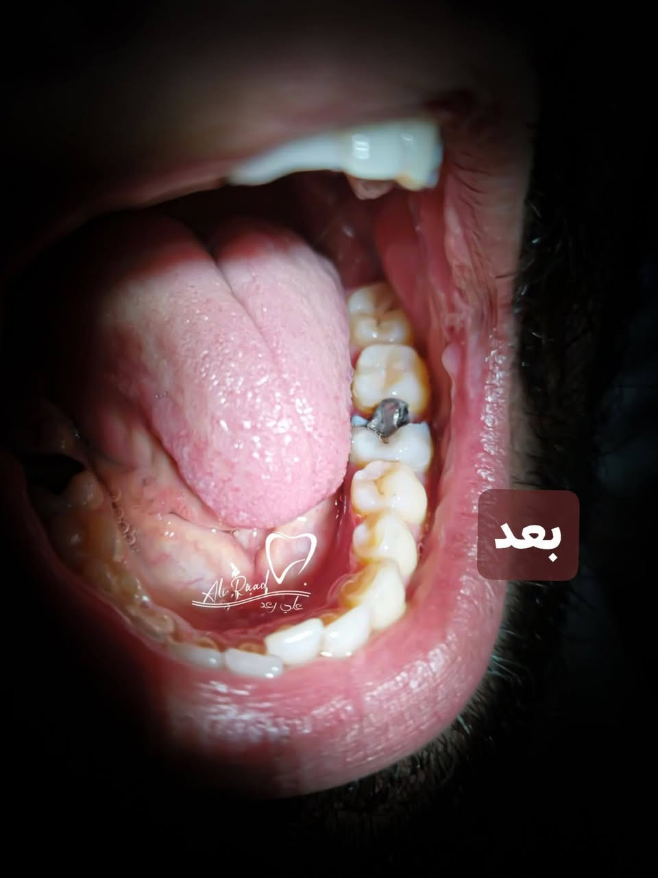 مجانا ..مجانا
سلام عليكم الي اسنانه بيهن تسوس ويريد يعالجهن..
متوفر حشوات ضوئية في عيادات كلية طب الأسنان جامعة بابل 
لحجز موعد ..علِّق وأرد عليك.
او الاتصال ***********
