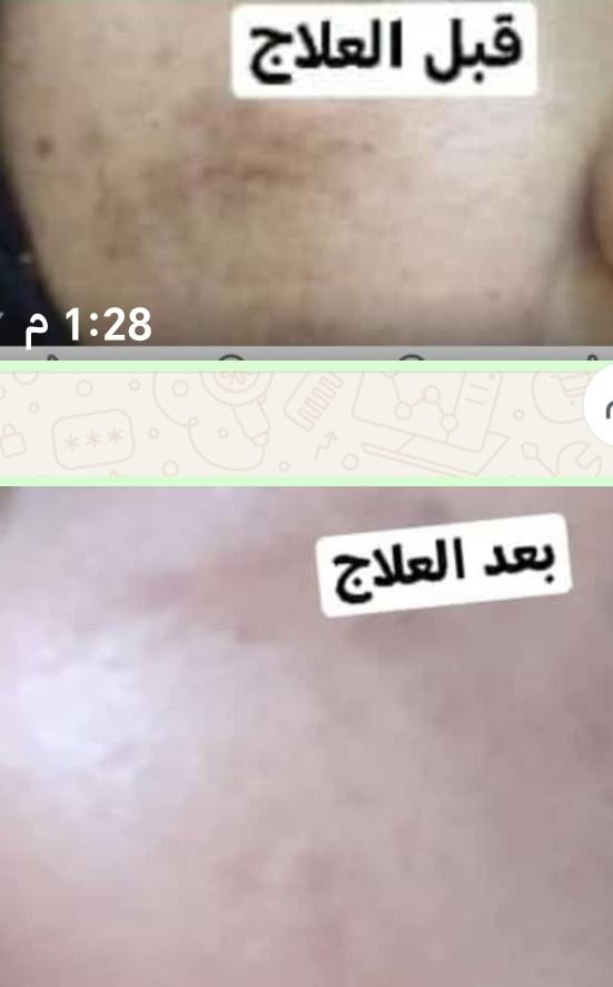 #جديدنا #
#خلطة وجة العروسة
#كريم الجمال +  #تبييض وتفتيح #البشرة وتنعيمها
تساعد على التخلص من#_ الكلف والنمش
تجديد طبقات الجلد والبثور
يزيل الهالات السوداء وحب الشباب والتجاعد والنمش وعلامات الشيخوخة الأخرى يرطب البشرة يجعل البشرة ناعمة وشابة يحمي البشرة من الأشعة فوق البنفسجية
احصلي على مظهر جميل ورائع أكثر من أي وقت مضى.


**إذا كنت صاحب هذا الإعلان وتريد حذفه لأي سبب، رجاءا أرسل رسالة إلى الدعم الفني**