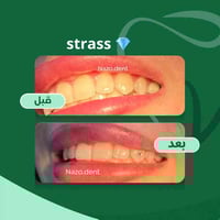 ستراس 💎💎لمسة جمالية فرق ناعم 🦷♥️ في عيادة نازوو للحجز والاستفسار عبر ا...