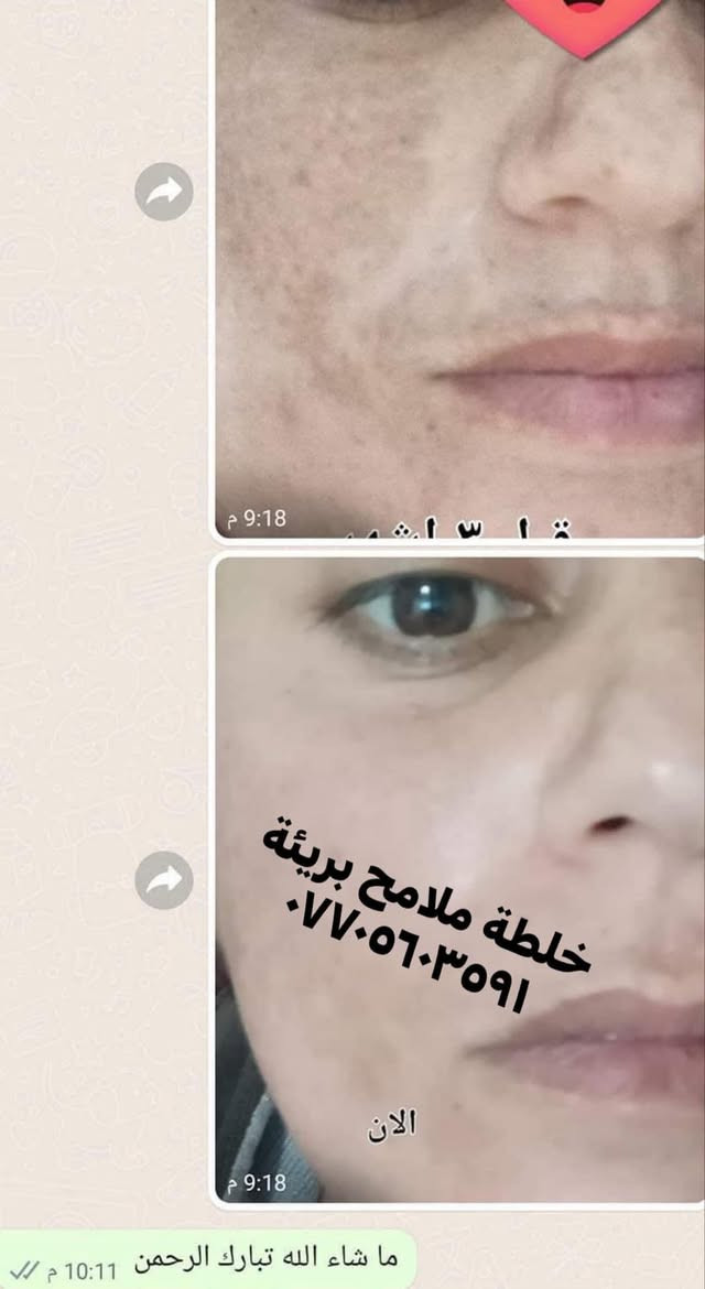 تم تجهيز خلطات لتبيض وتفتيح البشرة مع معالجة الكلف والتصبغات  ✨

بدون اي اضرار للبشرة خلي بشرتك اجمل مع خلطة ملامح بريئة
او راسلونا عالخاص


**إذا كنت صاحب هذا الإعلان وتريد حذفه لأي سبب، رجاءا أرسل رسالة إلى الدعم الفني**