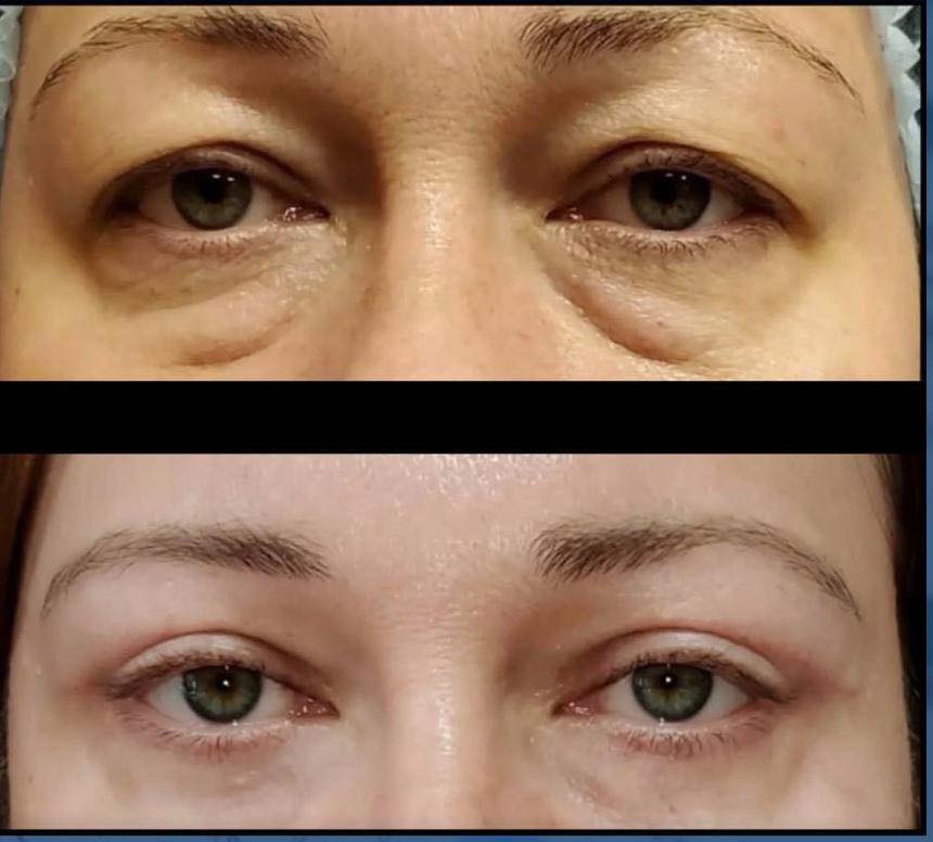 عمليات قص الأجفان متوفرة الآن بعيادتنا 
بغداد ناحيه الرشيد السوق 
***********
50% تخفيض لأول خمس عمليات
