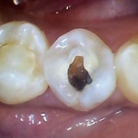 حشوة جذر • د. عمار عباس • بغداد الشعب