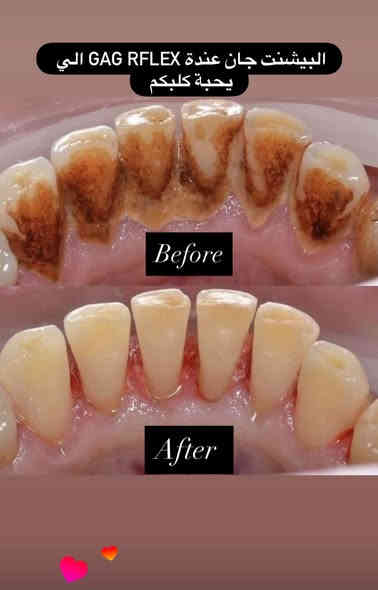 شلون حتشوفني بعيادة هملايا اذا تزورني كل
٦ اشهر كل سنة و كل سنتين و كل 4 سنين 

✨ ابتسامتك… أمانة بين أيدينا ✨
في عيادة د. (مهند السعدي) نعتني بكل تفصيلة في أسنانك، من أبسط ألم إلى أجمل ابتسامة.
✔️ حشوات تجميلية عالية الدقة
✔️ تبييض آمن بنتائج فورية
✔️ علاج عصب بأحدث الأجهزة
✔️ ابتسامة هوليود بدون مبالغة
✔️ متابعة ناعمة للأطفال
مكان واحد يجمع الراحة – التعقيم – الدقة – والنتيجة الذهبية…
نسعد بزيارتكم يومياً من الساعة 2 ظهراً و إلى ٩ ليلاً

📍 العنوان: حي المهندسين / شارع الخيمة / فوق اسواق كوب
📞 لحجز المواعيد :***********
