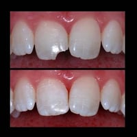 اي شخص عندة اسنان امامية مكسورة نسويلة حشوة تجميلية بلون السن ، النقل ...
