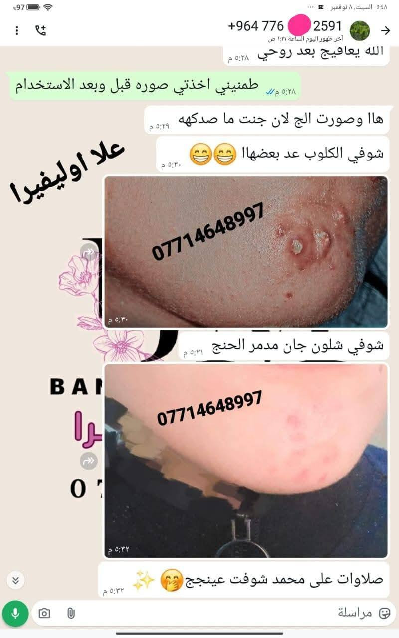 🙏انتبااااااااااه 🙏  الحجز فقط (وتساااااب ) علا اوليفيرا  ***********77
الي يعانوون من جميع مشاكل البشره مع منتجاتنا الطبيعيه  تمتعي ببياض الثلج 😍
 معالج الفااوربتين و السيراميد والعنبر وسيروم الباكشويل وسيىوم النضاره بكج متكامل 
تفتح البشرة 7 درجات والنتيجة دائمية 👌 وهذي تجارب زبائني تشهد 
خدمه توصيل لجميع محافضات
