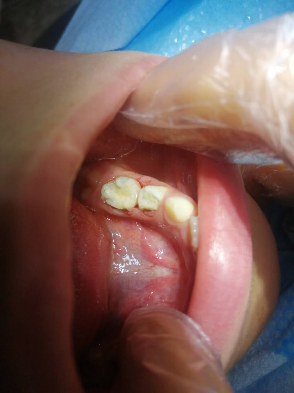 د مهند عبد الجواد الطحان الهاشمي.. ماجستير ودبلوم عالي تعويض الأسنان.. سايدين مستشفى #القياره العام.. مجاور صيدليه عبدالله المعماري. طابق ارضى. ***********#
