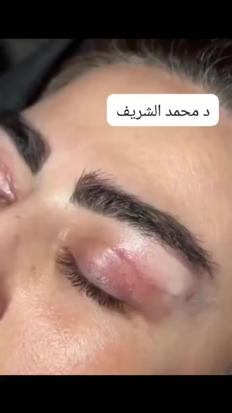 ودّعي ترهلات الجفون!🤝✨🤍🤍🤍🤍🤍
______________________________________________
رفع الجفون العليا
عيون أصغر، نظرة مرتاحة وشابة 🤍

👩🏻‍⚕️ بإشراف:
الدكتورة مروه عادل العامري
الدكتور إبراهيم عصام
الدكتور محمد الشريف

🩺 معاينة مجانية
📍بغداد- المنصور – الداودي
📞 ***********
