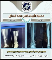 تثبيت كسر ساق • الشيش المغلق • جلولاء