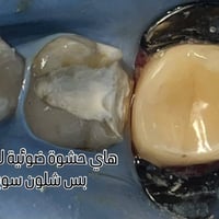 حشوت الجذر • عيادة بيانو • حي 17