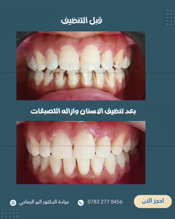 متواجدين اليوم من 4 ل 7 مساء
 (عيادة الدكتور أثير حليم الرماحي) 
☎️ للحجز والاستفسار ***********
او مراسلة الصفحة
📍 الموقع: 
الديوانية- قضاء عفك/شارع الأطباء قرب صيدلية أكرم البديري بناية الدكتورة مروة حمود التميمي الطابق الثاني
