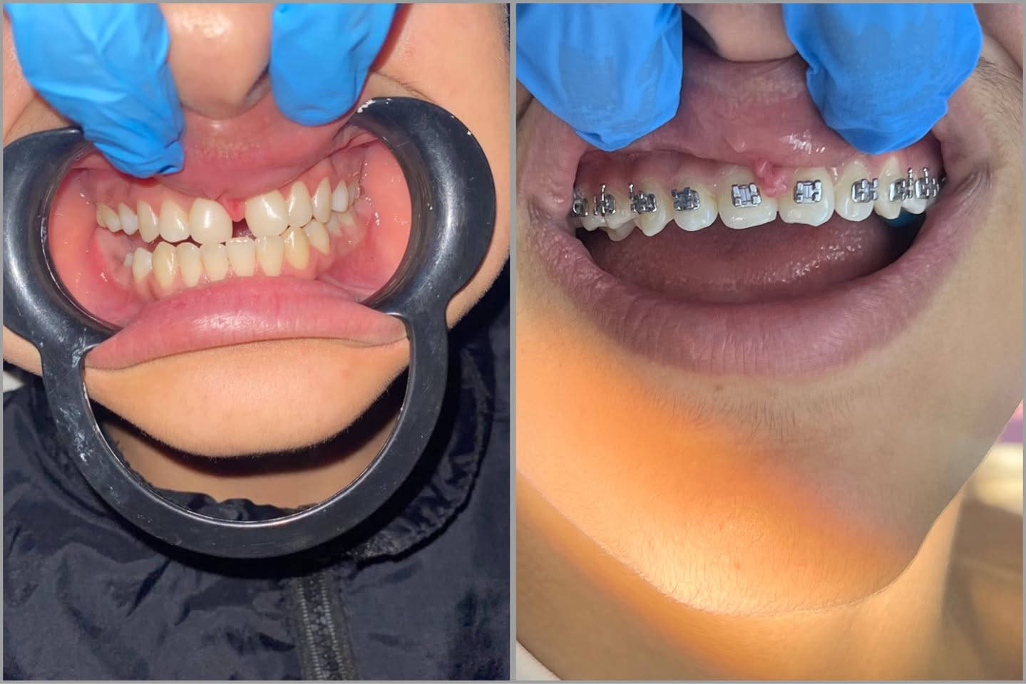 حالات تقويم الاسنان بعيادتنا
بايد د. فاطمة جميل 
للحجز والاستفسار ***********
الحسينية شارع المكاتب قرب السوق الصغير فرع صيدلية العجلان
