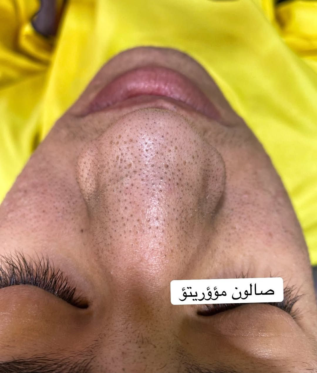 تعاني من الرؤوس السوداء والبشره الدهنيه🧏🏿🧏🏻

ماعليك بس تحجز 📞📞
ازاله الرووس السوداء 
التقشير المائي وازاله الدهون🧑🏻‍🔬
التقشير الكاربوني 🧔🏻‍♀️
للحجز مراسله الحساب او الاتصال 
***********📞
