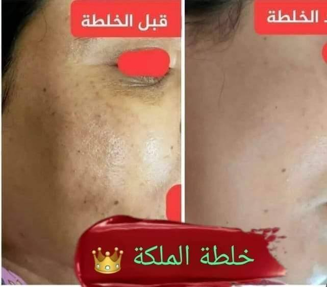 خلطه سن شاين♥♥الاصليه♥♥
معجزة التبيض الضمان حقيقي للمنتج
نتائج واضحة بعد 3 ايام من الاستعمال😲😲😲

 ((مع ابرة النضاره الملكيه)) 

🌹 فوائد الخلطه👇🏻👇🏻👇🏻
1-التبيض 7 درجات. 
2-ازالة التصبغات.
3-ازالة الكلف و النمش.
4-ازالة التجاعيد(ان وجدت).
5-ازالة هالات السوداء تحت العين.
6-تضيق المسامات.
7-ازالة حب الشباب و اثار الحب. 
8-امن للبشرة الحساسة و مناسب لجميع البشرات الدهنية و وجافه
للحجز والاستفسار واتساب رقم تلفون ***********
