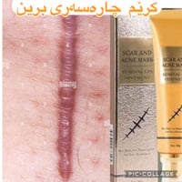 إزالة ندبات • ندبات قديمة وجديدة • السليمانية
