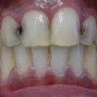 علاج أسنان مجاني • تنظيف وقلع • الدورة شارع الستين