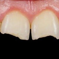 اذا احد أسنانه هيج متوفر علاج (مجاني) جامعة الفراهيدي 07731577776  علم...