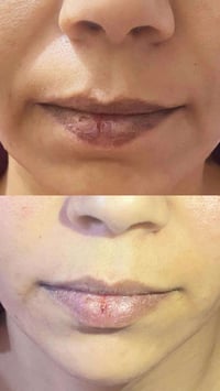 حقن الخطوط الضاحكة 2cc د. نور رياض الحمداني 07805206149 للحجز و الاستف...