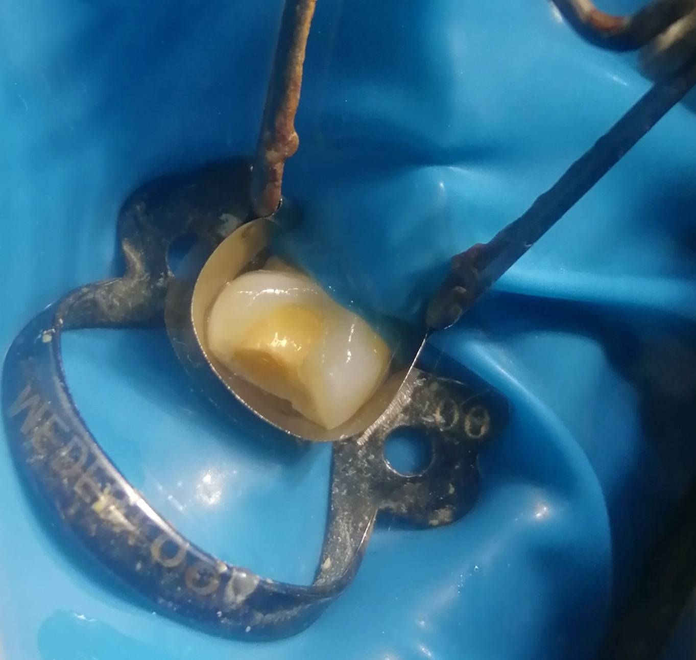 حشوه تجميليه للسن الضاحك العلوي باستخدام العازل المطاطي..
د مهند عبد الجواد الطحان الهاشمي
ماجستير ودبلوم عالي تعويض الأسنان
سايدين مستشفى#القيارهالعام
مقابل باب الطوارى الرئيسي
مجاور صيدليه عبدالله المعماري للحجز والاستفسار التواصل على الرقم ***********# طابق ارضى.
