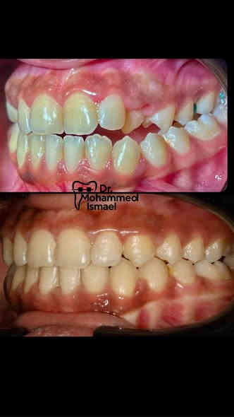 يسرنا اعلامكم بتواجد
الدكتور محمد اسماعيل المشهداني
اخصائي تقويم الاسنان
نقدم لكم خدمات تقويم الاسنان المعدني والشفاف وزراعة الاسنان (بأحدث الانظمة وبالتقسيط )
،
حشوات تجميلية، حشوات جذور، وقلع جراحي

العنوان: الخالدية-شارع عشرين- مجمع الطائف الطبي
للحجز والاستفسار: 
يمكنكم التواصل عبر الواتساب او الاتصال على الرقم:👇
                          📞 ***********
،

لمشاهدة الحالات التي تم علاجها زورونا على صفحة العيادة
https://www.facebook.com/share/1Do88FgLBa/?mibextid=wwXIfr
،
(كتب الله لكم السلامة والعافية من كل مرض)
