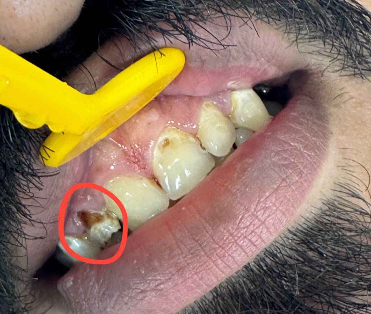 علاج الاسنان مجاناا 😇❗️
يعلن الدكتور حسين علي عن بدء استقبال المرضى في عيادات جامعة المشرق وعلاجها مجانا بالكامل 

اذا عندك مشاكل باسنانك تواصل وياي واحجز موعدك راح نعالج كلشي بإذن الله 🙏 

الحالات الي نعالجها 👇
1-قلع الاسنان 
2-الحشوات الضوئية
3-تعويض الاسنان المفقودة 
4-تنظيف الاسنان 

احجز موعدك عبر الواتساب عبر الرقم *********** 

موقع العيادات في جامعة المشرق الكائنة في شارع مطار بغداد (مقابل ساحة عباس بن فرناس) 

المقاعد محدودة جدا
