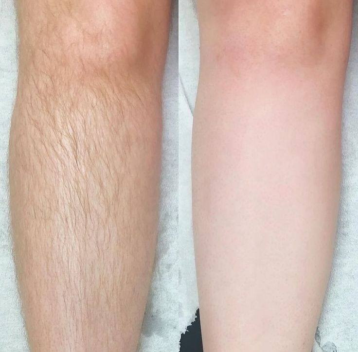 حابة تحصلين علة جسم املس وفرتلج عرض كلش راح تحبينة 🥰😍

مزيل الشعر يشيل جميع الشعر من الجسم وحتى من الوجة 

مع زيت السعد لي سوي لمعة بجسم وينعم الجلد ويقلل نمو الشعر 

يعني هم راح تخلصين من الشعر وهم راح يقل عندج نمو الشعر يجسم  

كل هذا وسعر مناسب وتوصيل مجاني لكل العراق 🏃🏻‍♀️🏃🏻‍♀️🏃🏻‍♀️


**إذا كنت صاحب هذا الإعلان وتريد حذفه لأي سبب، رجاءا أرسل رسالة إلى الدعم الفني**