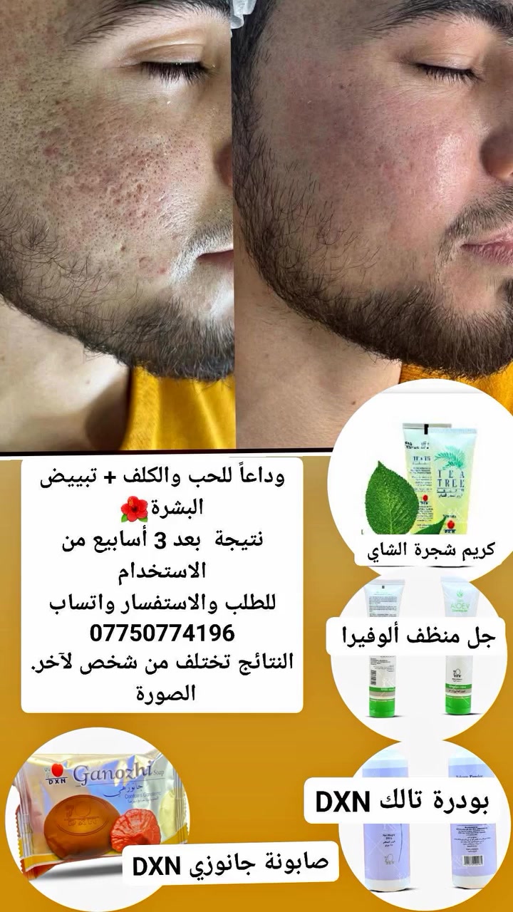 شوفوا الفرق خلال 3 أسابيع بس 👇
من حبوب وكلف ومسام واسعة → لبشرة صافية

مجموعة DXN الطبيعية: تنظيف + علاج + تفتيح + حماية
النتائج تختلف من شخص لآخر.

منو تريد تعرف تفاصيل المجموعة والسعر؟ 
علقي "تم" أو راسليني واتساب: *********** 
#منتجات_DXN #علاج_الحبوب #بشرة_صافية
