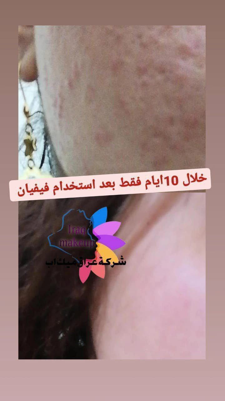 🔥كريم فيفيان الاصليه فقط100.يوحد لون البشرة-يرطب وينعم البشرة-يقضي على التصبغات-ينشط البشرة ويعطيها نضارة-يقلل من الهالات السوداء-يقلل من النمش-خفيف على البشرة وسهل الامتصاص يخفي كلف ونمش وحب شباب واثاره تبيض خورافي للبشره افضل خلطه ممكن تستخدميه


**إذا كنت صاحب هذا الإعلان وتريد حذفه لأي سبب، رجاءا أرسل رسالة إلى الدعم الفني**