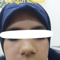 تقويم كسر الانف • بدون جراحة • حلة الطهمازية