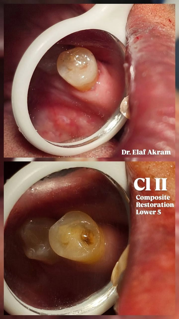 السلام عليكم
ابتداءاً من يوم الاحد راح ترجع العيادات التعليمية لجامعة الهادي تفتح
نستقبلكم من خلالها ونقدملكم علاج للاسنان من حشوات وتتظيف وقلع وتعويض بالاطقم المتحركة وهذا بعض شغلنا اني وزملائي وجميعهم جانوا راضين بالنتائج.
 للمهتمين تكدرون تتواصلون وياي ونرتب موعد سريع ومضمون ومجاني.
***********
