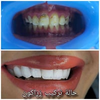 زراعة الأسنان • تلبيس الأسنان • فينير • ابتسامة هوليود • تقويم الأسنان...