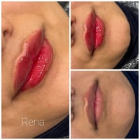 فيلـــــــر  شـــــــــفة " 💋☘️  مع رينا لليزر والتجميل   🎀 يتواجد ڪاد...