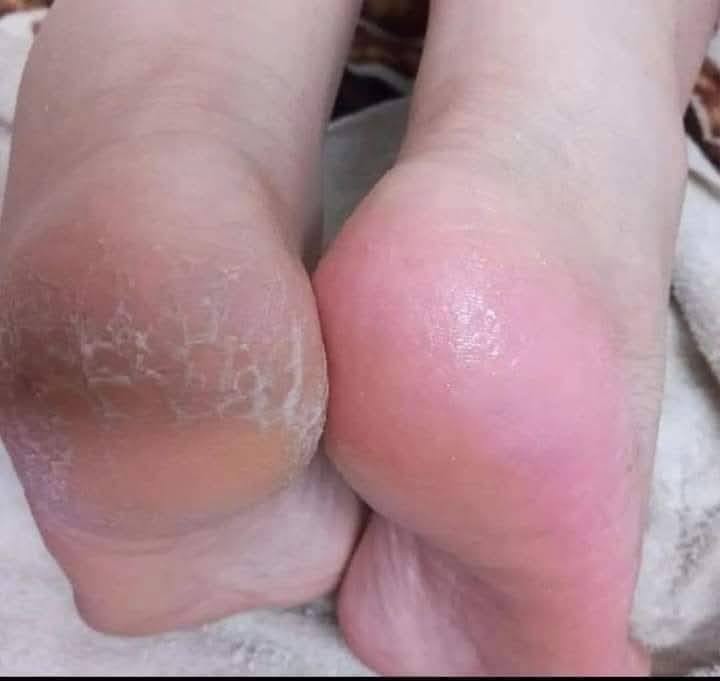 عمي بلاش  انطيجن خلطه  لتشققات او فطور قدم امانه الله من اول استخدام فرق وتنطي  وترطب. تورد ب3الاف فقط  تاخذيها وشوفي شغلها يخبل  وسعرها مناسب توصيل داخل الحسينيه متوفر يوصلج بنفس ليوم كميات محدوه


**إذا كنت صاحب هذا الإعلان وتريد حذفه لأي سبب، رجاءا أرسل رسالة إلى الدعم الفني**